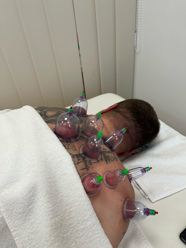 Vakuum terapija (cupping) — kupice postavljene na rame i leđa pacijenta