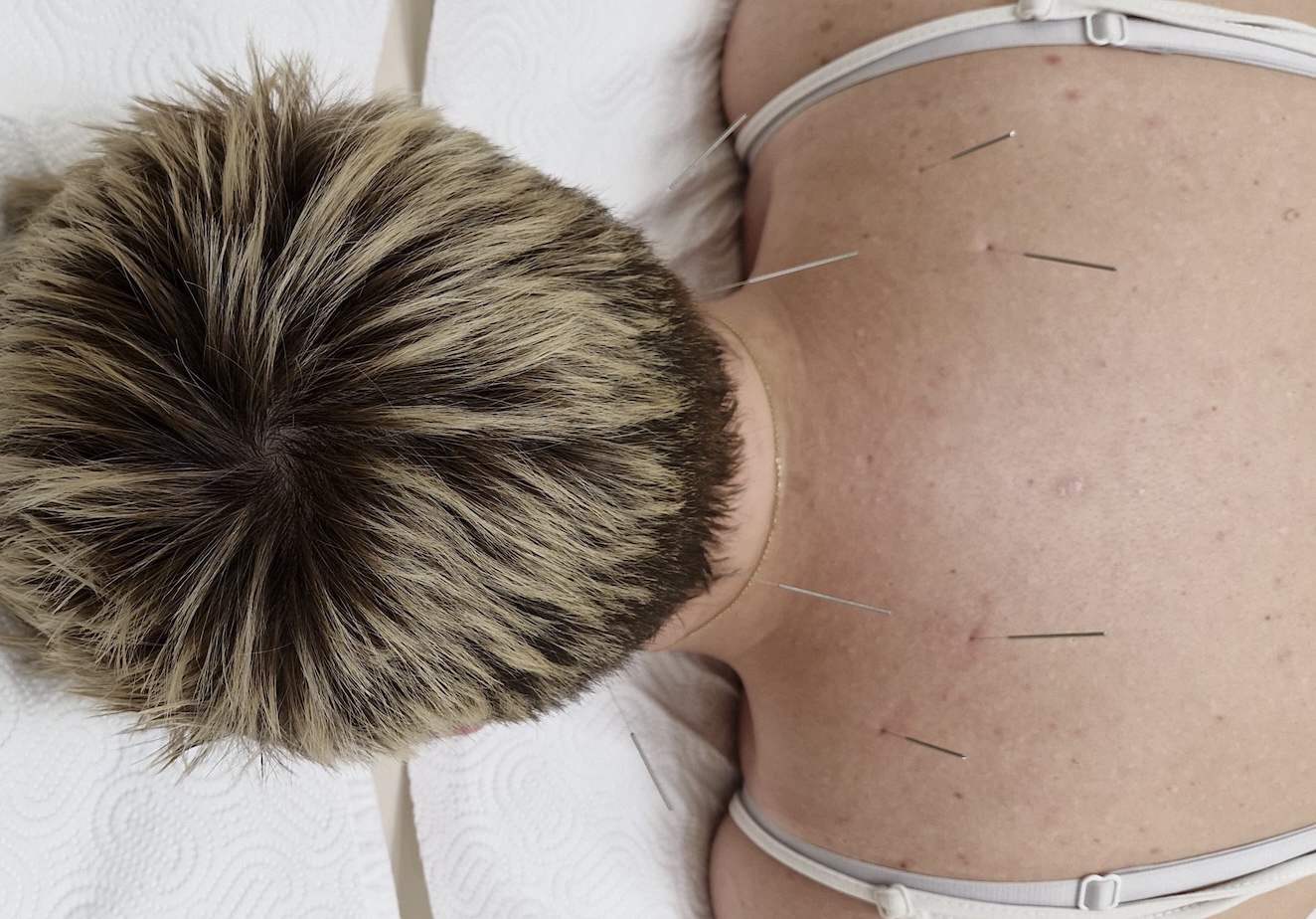 Acupuncture photo
