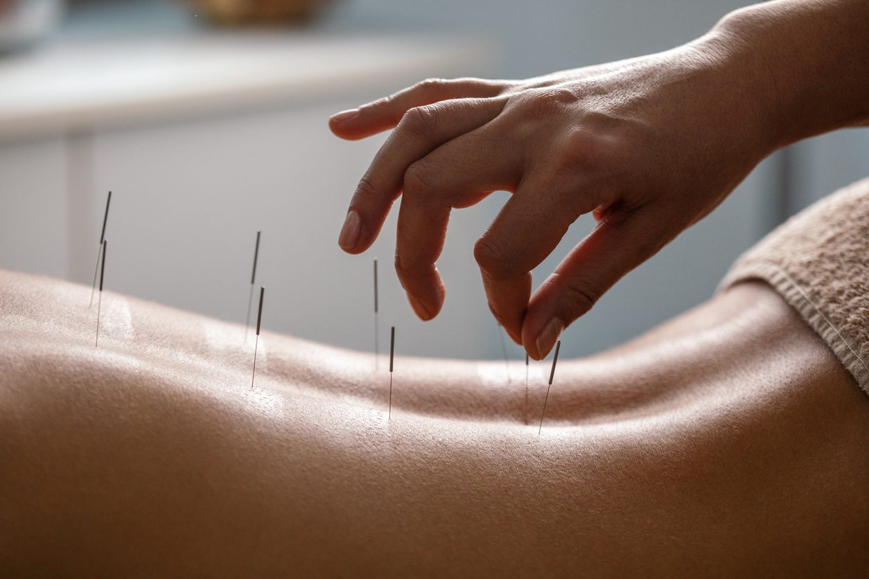 Acupuncture thumbnail