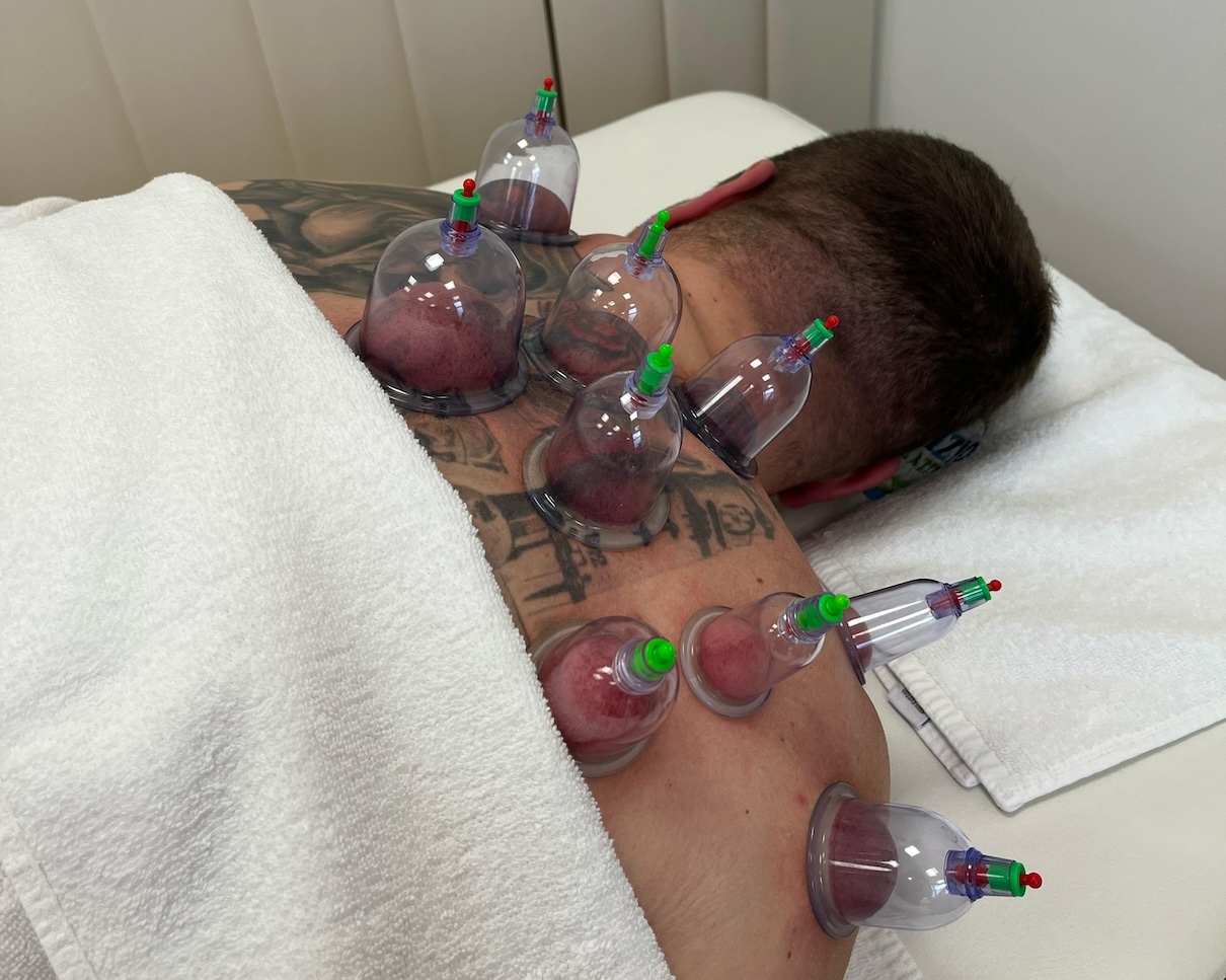 Cupping device